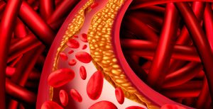 dislipidemia 2