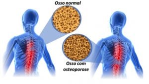 desmineraliza%C3%A7%C3%A3o %C3%B3ssea 2