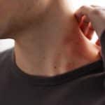 Herpes-zoster: Imagem de Freepik.