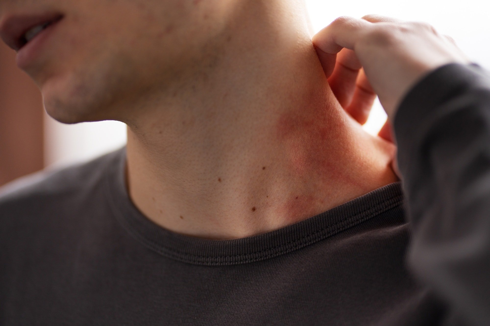 Herpes-zoster: Imagem de Freepik.