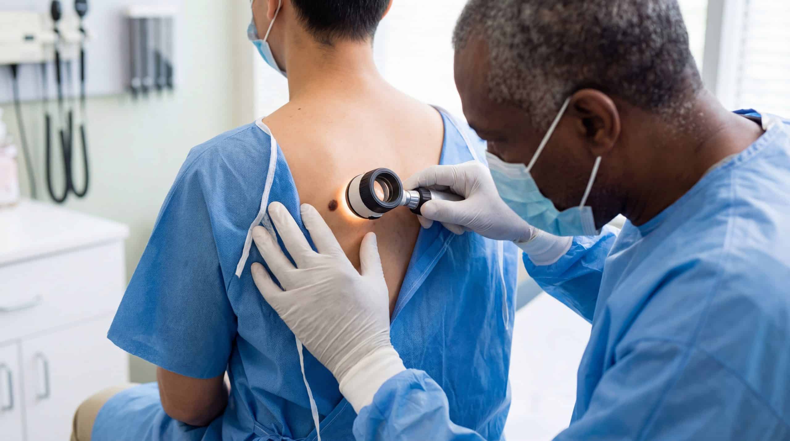 Médico negro com avental cirúrgico azul e luvas brancas examina pinta nas costas de paciente branco ao investigar câncer de pele